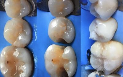 Otturazione? Come farla Quanto dura