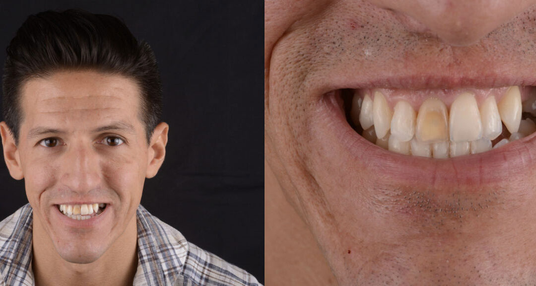 Dente scuro risoluzione con una FACCETTA DENTALE