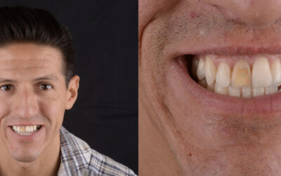 Dente scuro risoluzione con una FACCETTA DENTALE