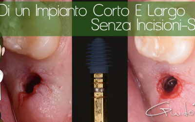 inserimento di un impianto corto e largo senza tagli