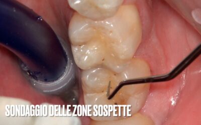 COME PUOI SAPERE SE HAI UNA CARIE?