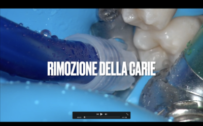 Come rimuovere una carie – Guarda il video
