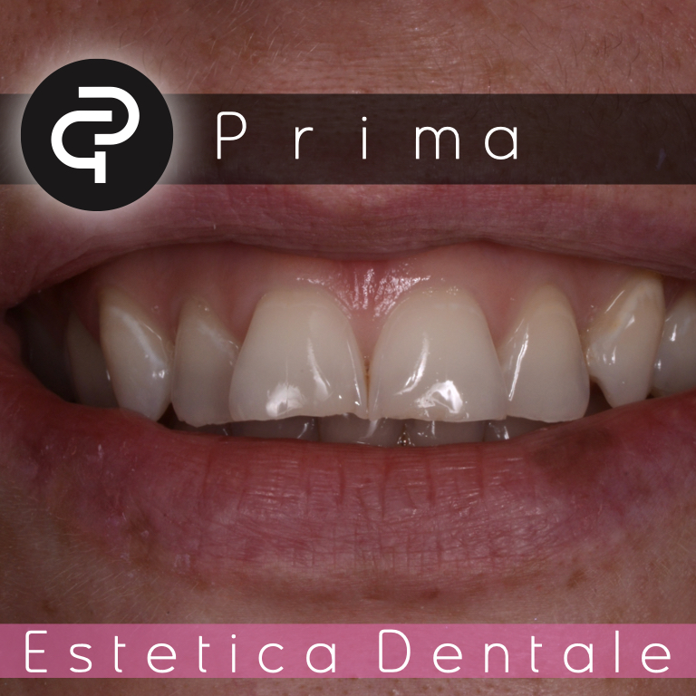 Prima Prima