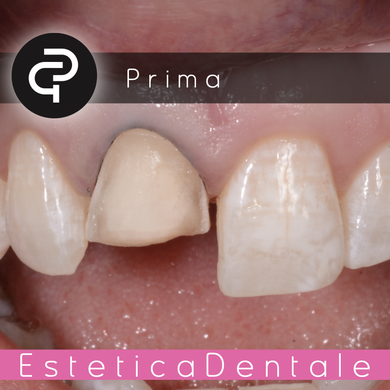 Prima Prima